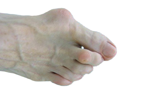 Natural feet are widest at the toes, strong, stable and painfree Shoe feet  are pointed (aka bunions), stiff, weak, unstable and usually