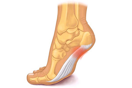 How to treat a Plantar Fascia tear