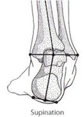 Supinated Foot