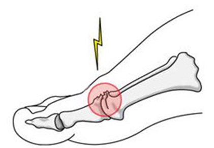 Arthritis of the big toe