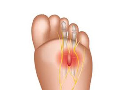 Neuroma